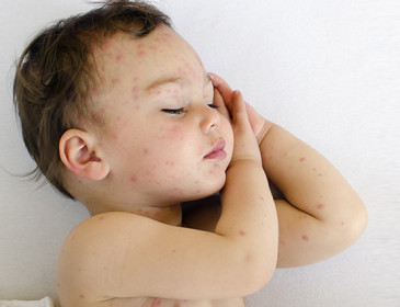 Come proteggere i bambini dalle zanzare (senza farne una tragedia)